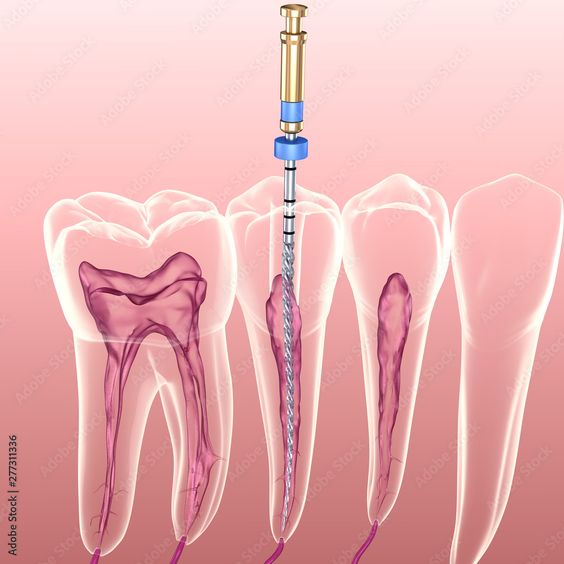 How to avoid damage to the apical stenosis during root canal preparation?