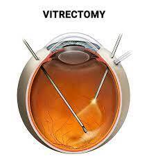 What Is Vitrectomy? – Bharti Eye Foundation