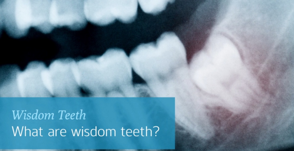 Find here everything to know about wisdom teeth