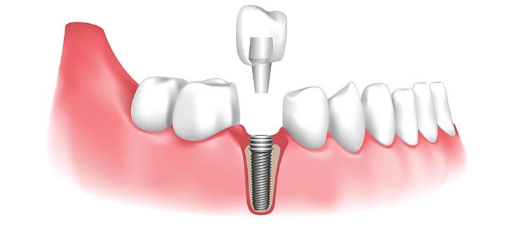 How to Find the Right Dentist for Your Implants