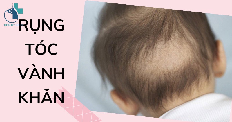 Rụng tóc vành khăn ở trẻ sơ sinh có dấu hiệu gì?