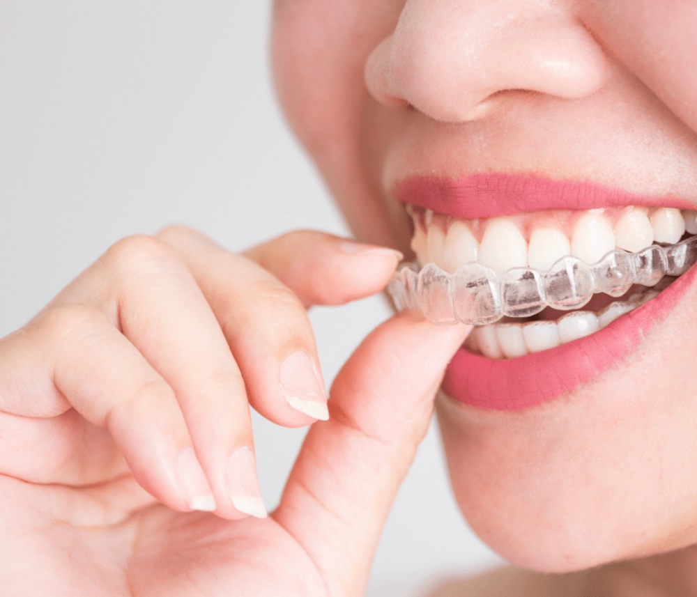 Invisible Aligners Cost