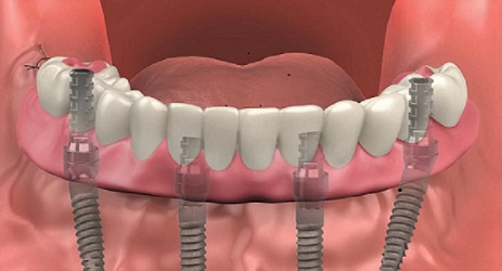 How I Found The Perfect Dentist Implant Near Me