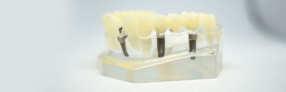 What are the advantages of dental implants near me?
