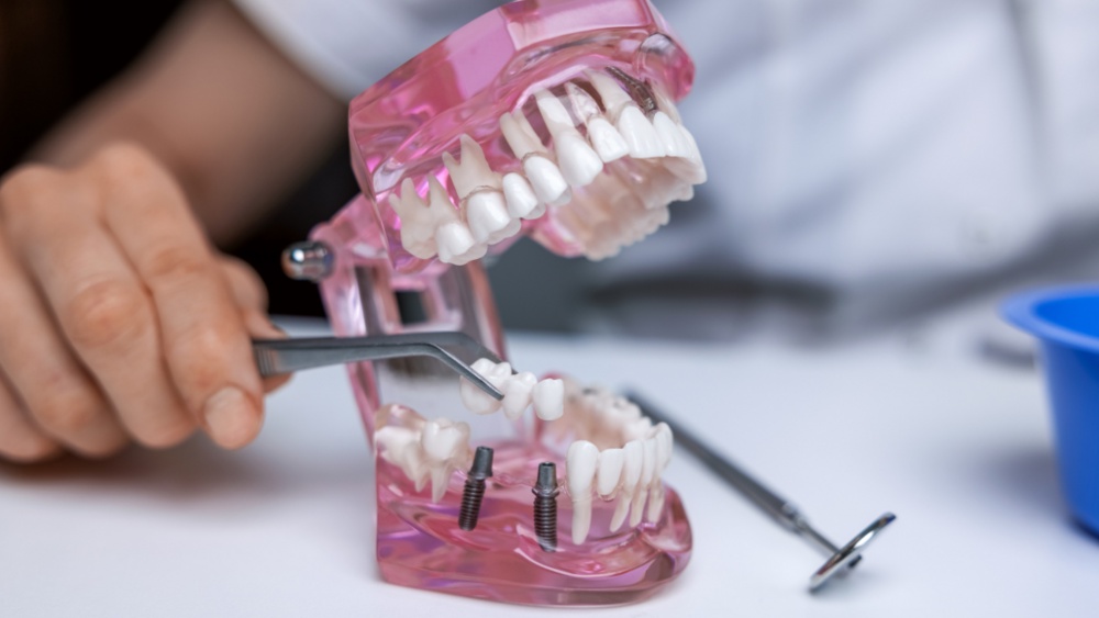 Improve Your Smile and Gain Functionality With Dental Bridges