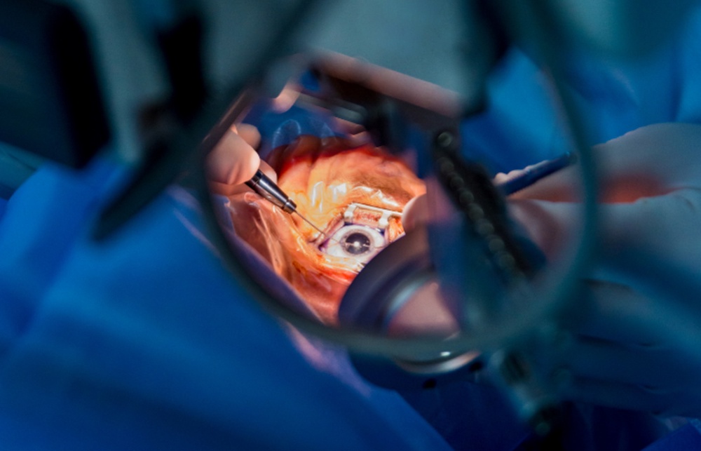 Cataract Surgery Basics: Types, Expectations, and Recovery