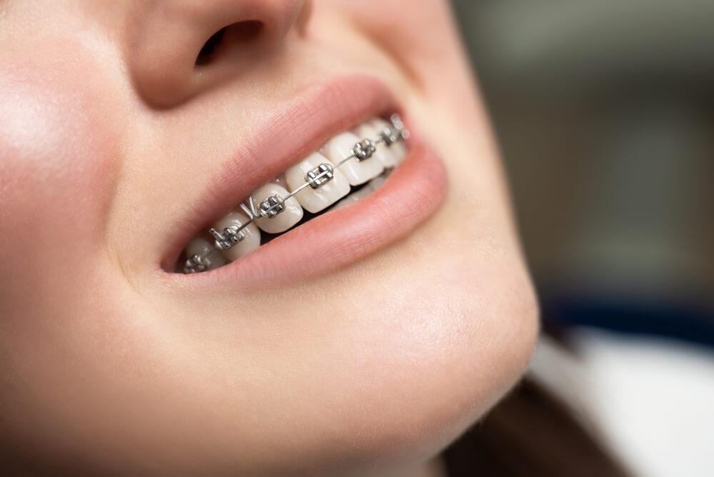 What Your Dentist Can Tell You About Dental Braces