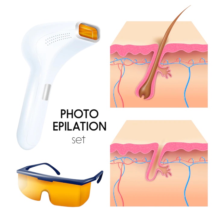 How Laser Hair Removal Technology Has Evolved