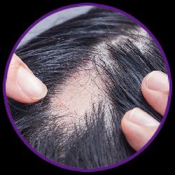 Find The Reputed Doctors For Hair Fall Treatments In Waghbil!