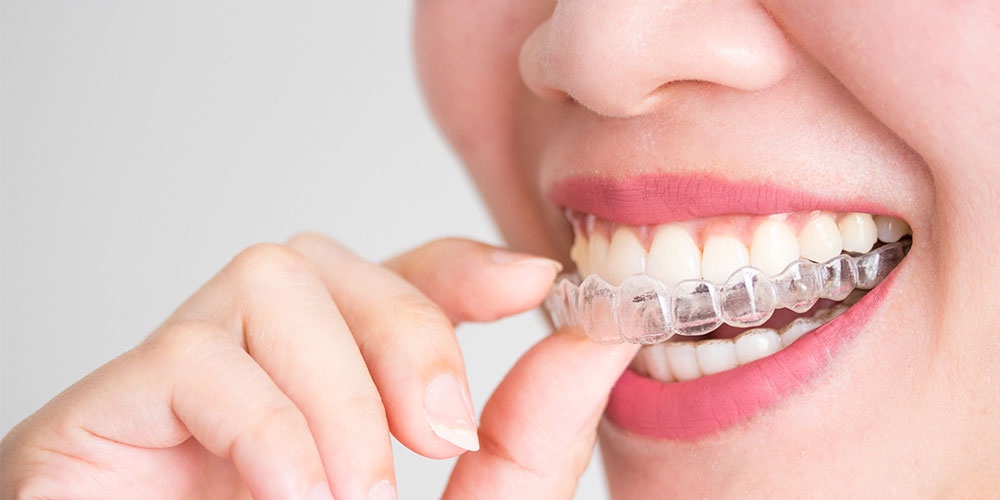 Invisalign Cost in Delhi - What are they and their benefits?