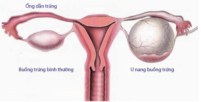 Bệnh u nang đơn thuỳ buồng trứng và thuốc điều trị