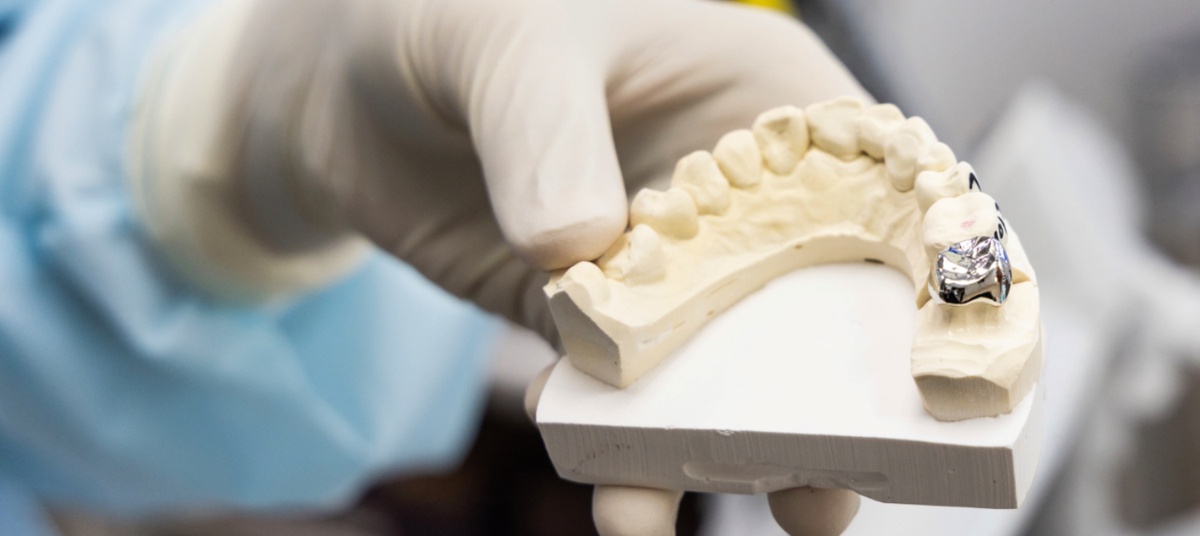 Why You Should Consider a Dental Crown from Tuscan Lakes Family Dentistry