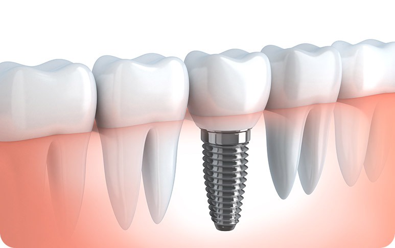 Precautions for dental implants