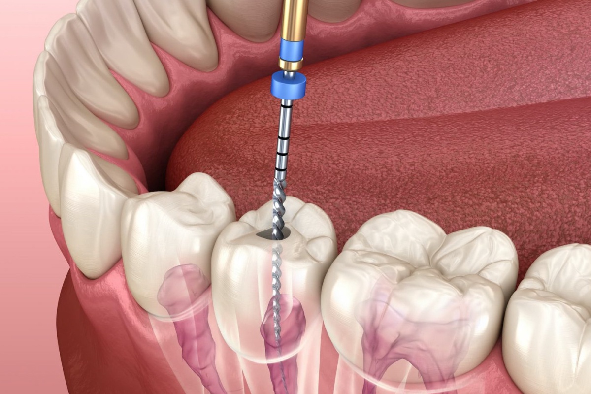 Smile Confidently with Dental Implants: A Long-Term Investment in Your Oral Health