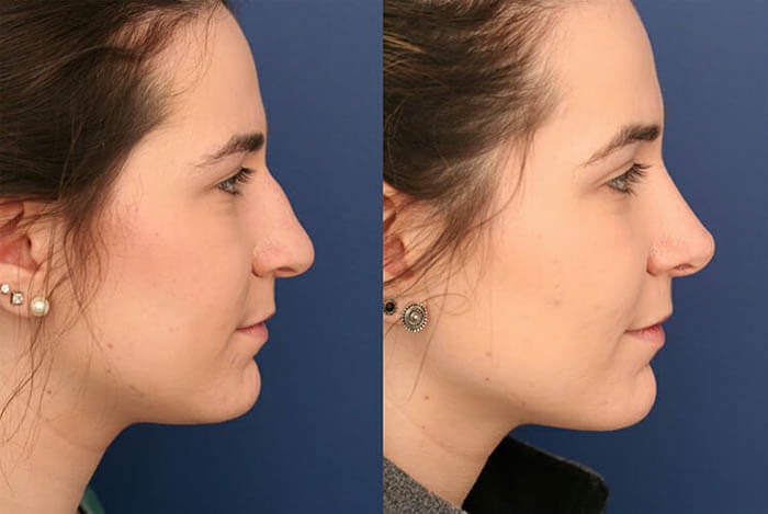 Considering a Nose Job: Here's What You Need To Know