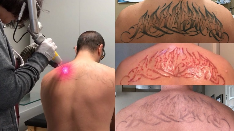 Laser Tattoo Removal: How To Remove A Tattoo With A Laser