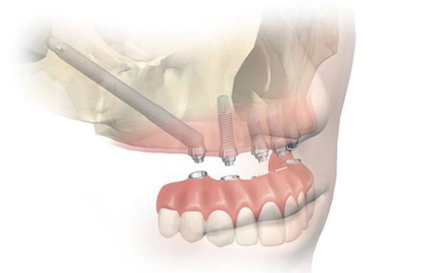 How Can Zygomatic Implants Help Patients With Jaw Bone Loss?