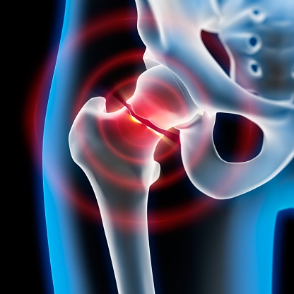 The Cost of Hip Fracture Treatment in Singapore: What to Expect