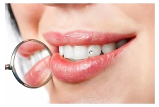 4 Myths And Facts About Best Painless Teeth Whitening Service In The Summit