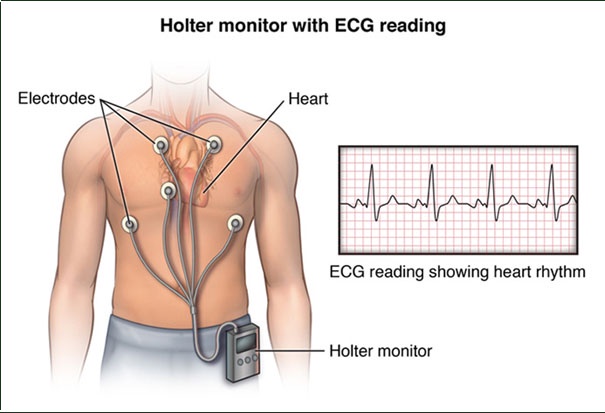 Get Holter Monitor Test For Your Heart Conditions In Dombivli!