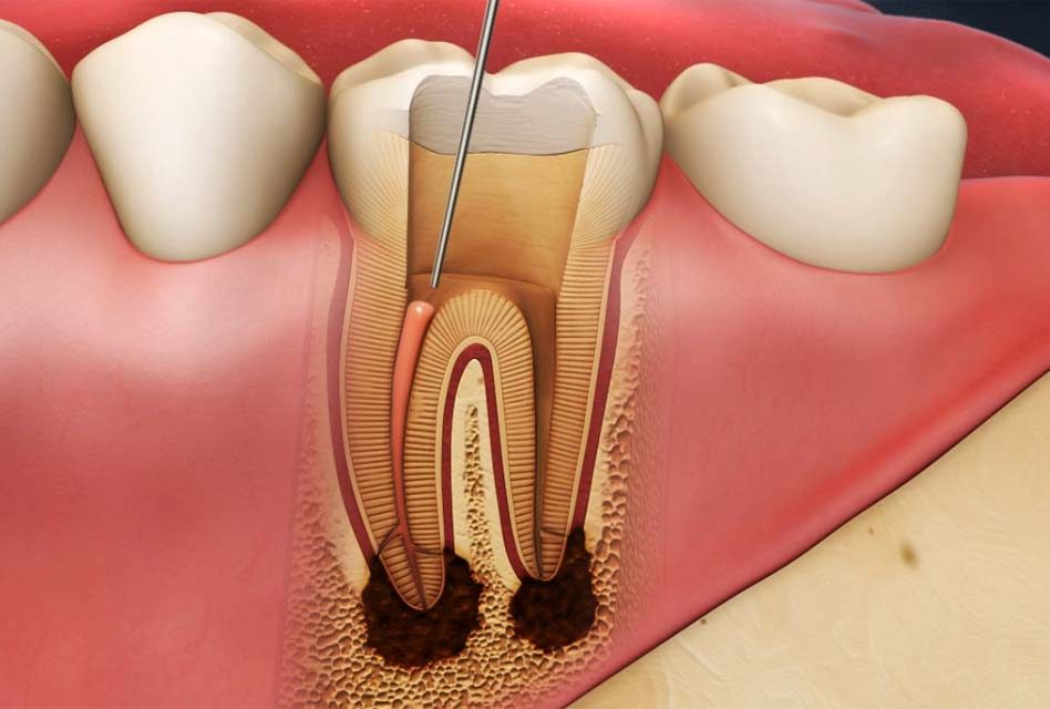 The Procedure of Endodontic Retreatment: What to Expect and How it Works