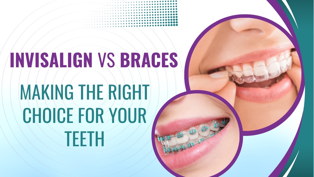 Invisalign Vs Braces: Making the Right Choice for Your Teeth