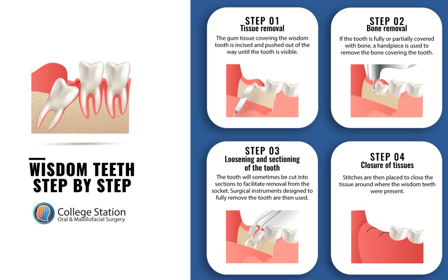 3 Most Practical Reasons for You to Remove Your Wisdom Teeth