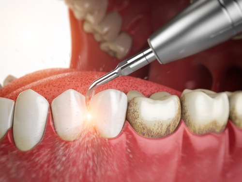 How Long are Dentist Cleanings: Understanding the Duration and Importance of Routine Teeth Cleanings