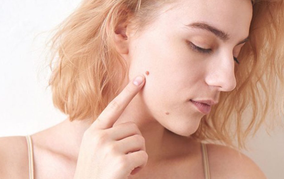 Coneflower Skin Tag Removal (Pros and Cons) Is It Scam Or Trusted?