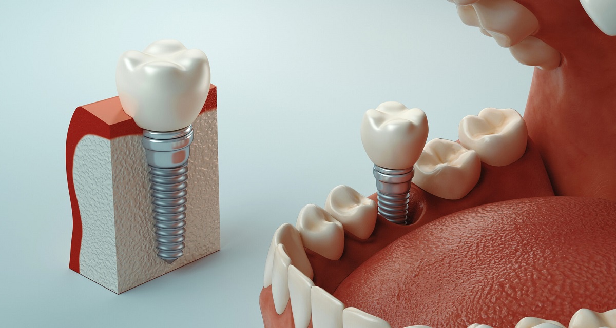 Single Implant - A Great Option For Replacing Missing Teeth