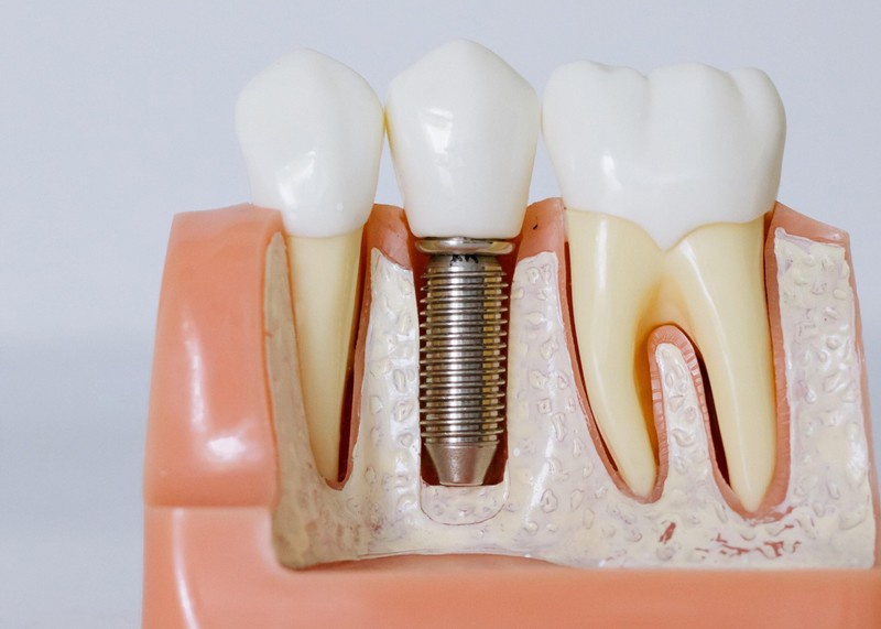 Dental Implants Can Breathe Life Back Into Your Smile