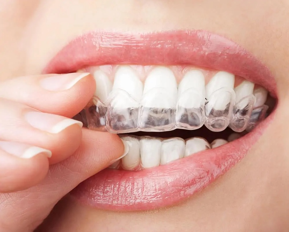 How much is invisalign without insurance