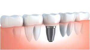 Dental Implant Surgery: Tips for a Successful Procedure in Dubai
