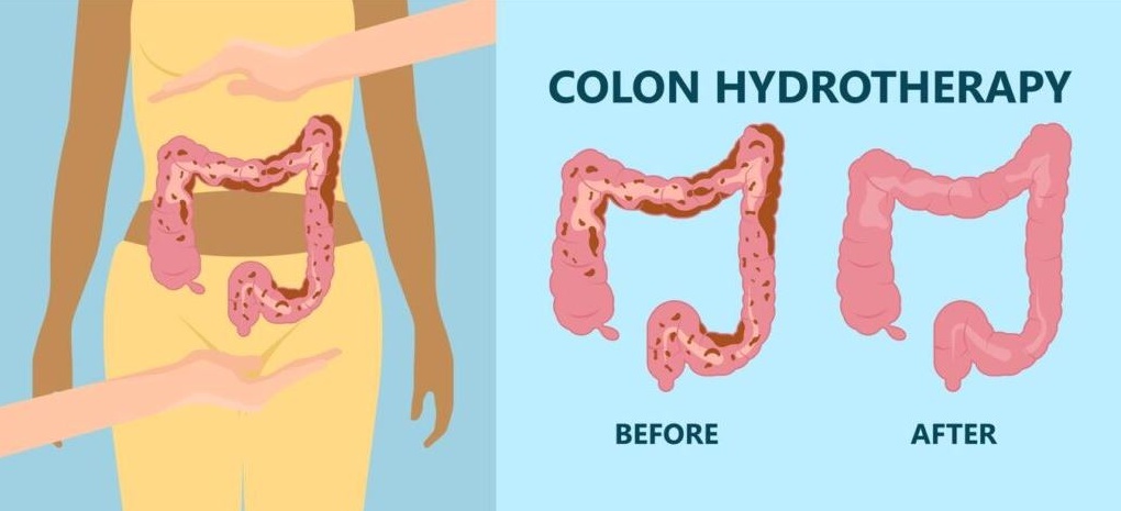 Colon Hydrotherapy: What To Expect And How To Prepare | Medical Massage Detox