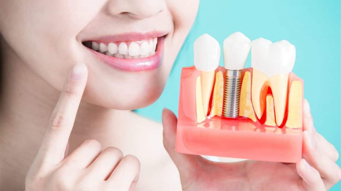 Consultation For Dental Implants: What To Expect & How To Prepare?