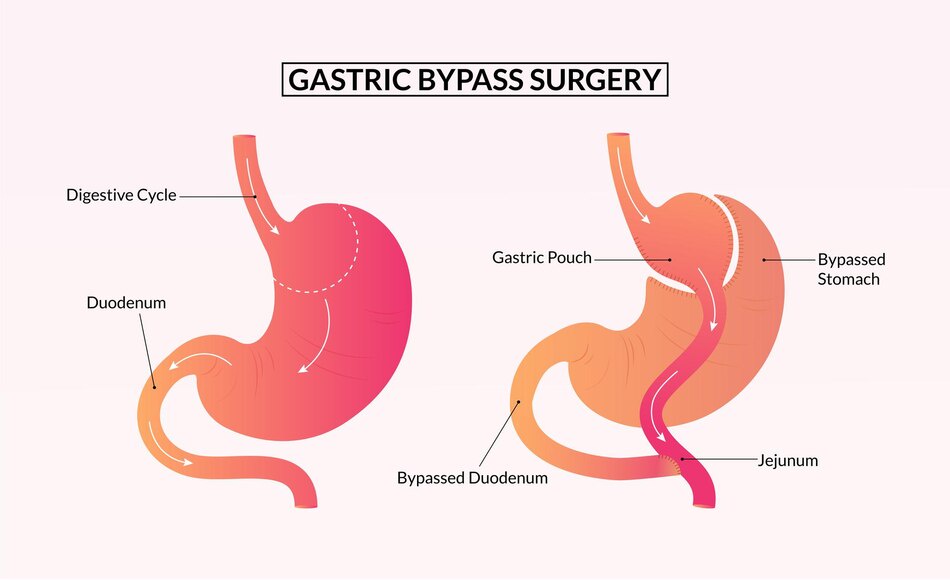 Why Gastric Bypass Surgery Is A Path To A Healthier Future?