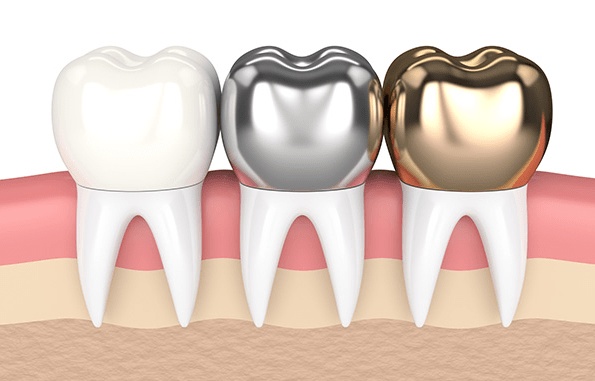 Restoring Your Smile With A Cheap Dental Crown