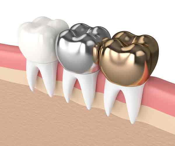 Enhance Your Smile with Dental Crowns in Mississauga