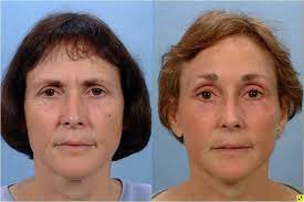 The Importance of Choosing a Qualified Surgeon for Your Face Lift