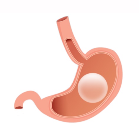 Taking Control Of Your Weight: The Science Behind ORBERA Gastric Balloon