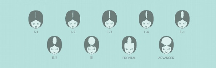 How Well-Aware Are You About Female Hair Transplants? A Review
