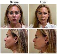 The Pros and Cons of Non-Surgical Facelift Alternatives