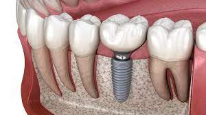 All You Need to Know About All-on-Four Implants: A Comprehensive Guide