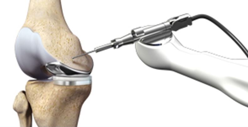7 Things You Must Know About Robotic Knee Replacement Surgery