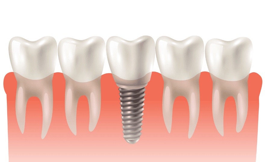 How Do Midtown Houston Dental Implants Improve Oral Health?