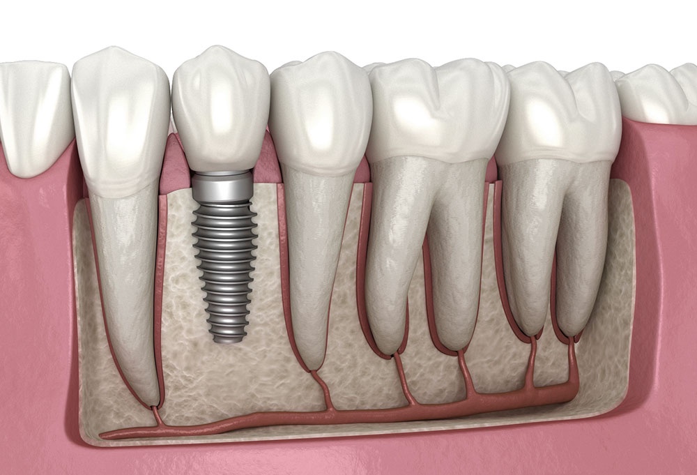 Dental Implants In London : Restoring Smiles With Confidence