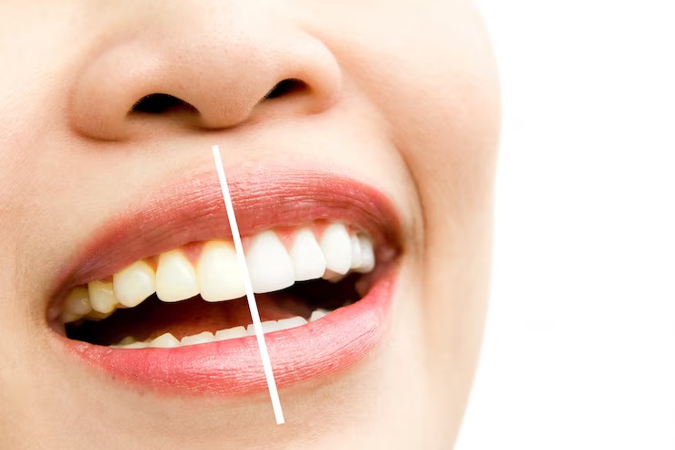 Teeth Whitening 101: Your Guide to a Brighter Smile