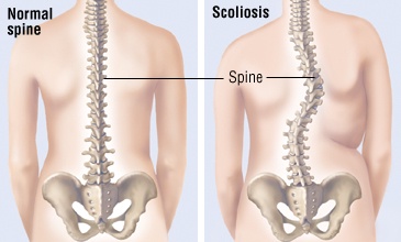 Unveiling the Signs and Symptoms of Scoliosis: A Comprehensive Overview