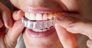 Unveiling Hidden Costs: Things to Consider When Budgeting for Invisalign Treatment