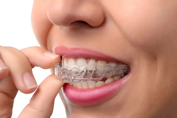 Can I eat and drink normally while wearing invisible braces?
